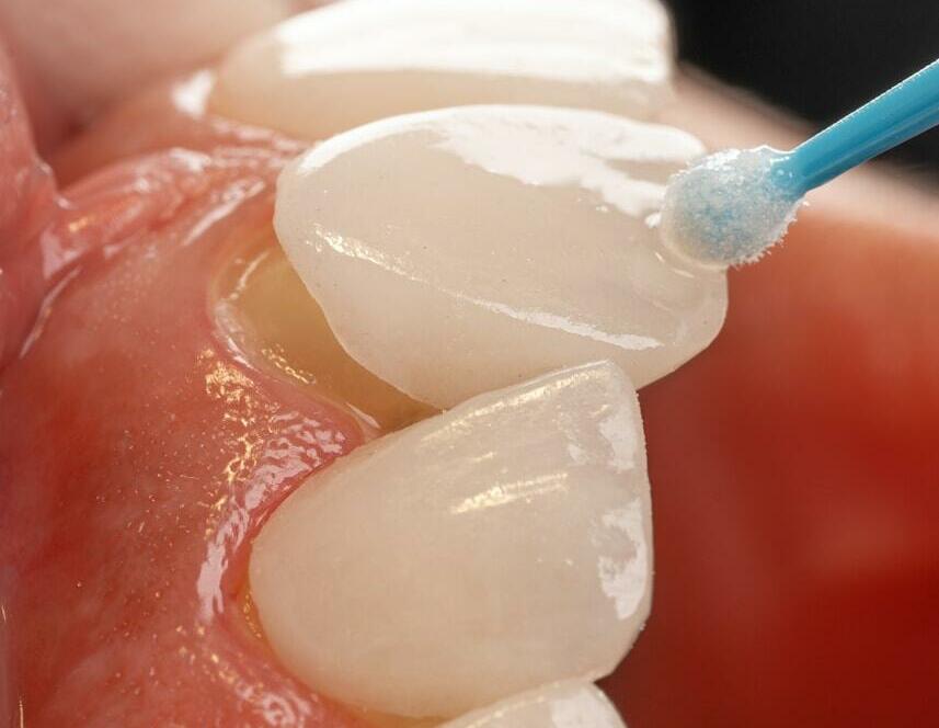 a tooth with a blue toothbrush in it