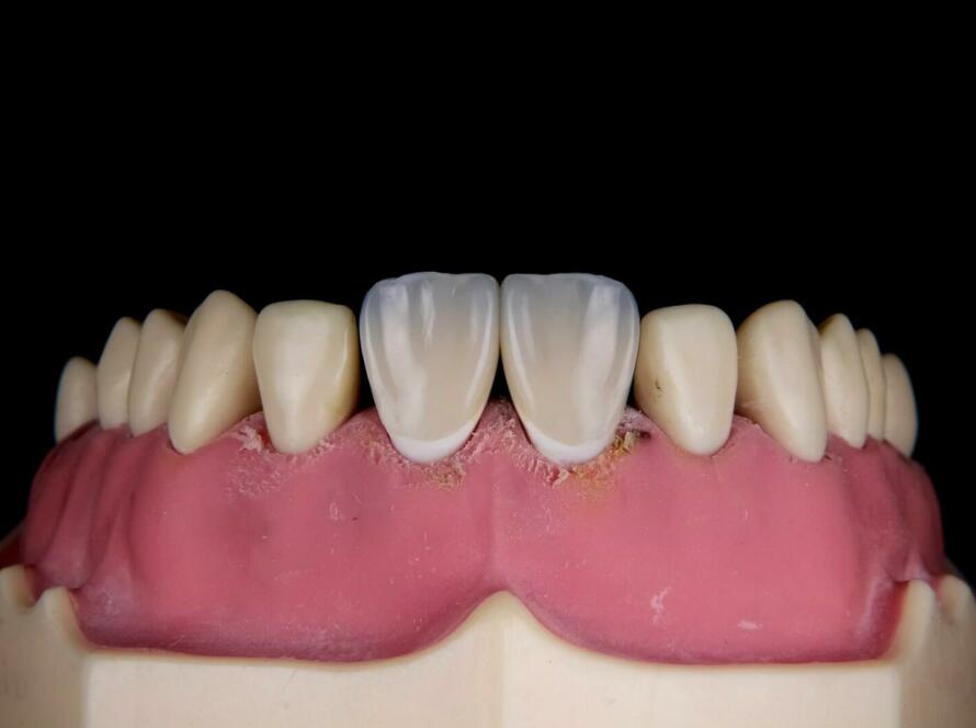 a close up of a tooth with gums on it